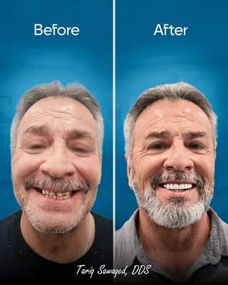 Before and after smile transformation, result 9