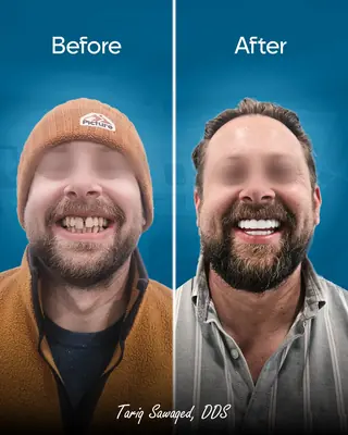 Before and after smile transformation, result 17