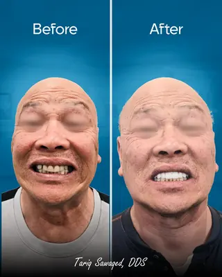 Before and after smile transformation, result 16