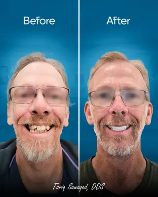 Before and after smile transformation, result 19