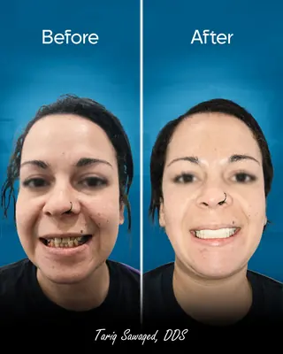 Before and after smile transformation, result 20