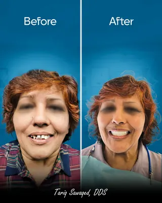 Before and after smile transformation, result 15