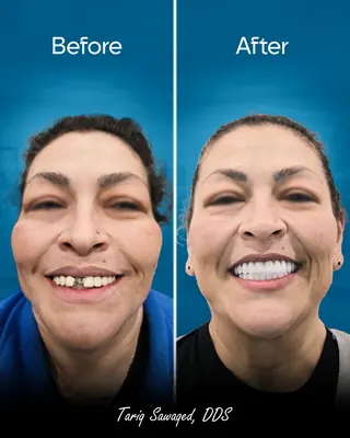 Before and after smile transformation, result 14