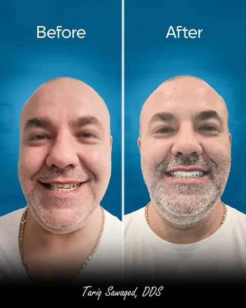 Before and after full-arch dental implant smile transformation