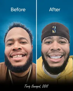 Before and after dental implant smile transformation