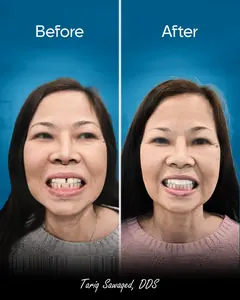 Before and after dental implant smile transformation